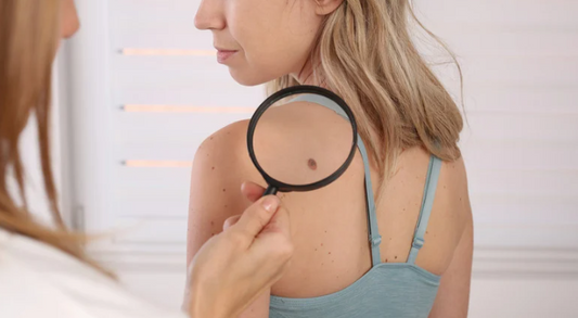 July 2025 Blog: Spot it Early: Skin Checks in  Primary Care